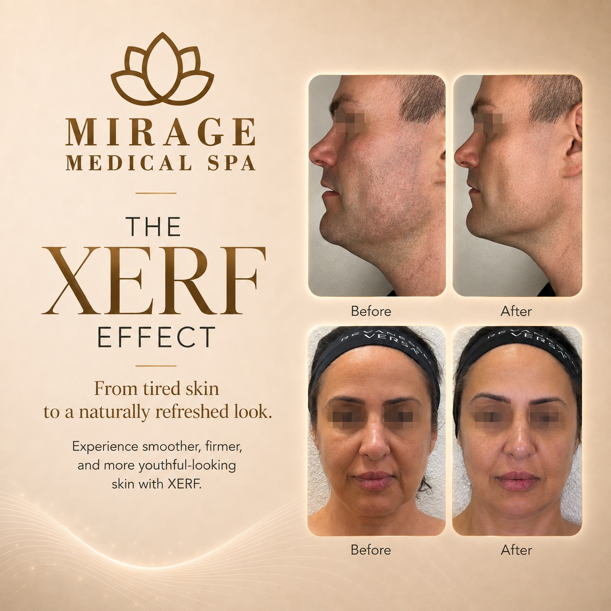 XERF before and after skin tightening results at Mirage Medical Spa in Palm Desert