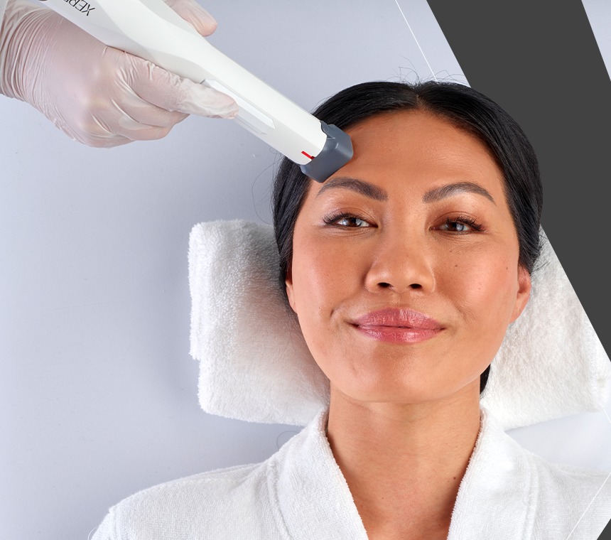 XERF RF skin tightening treatment in progress at Mirage Medical Spa